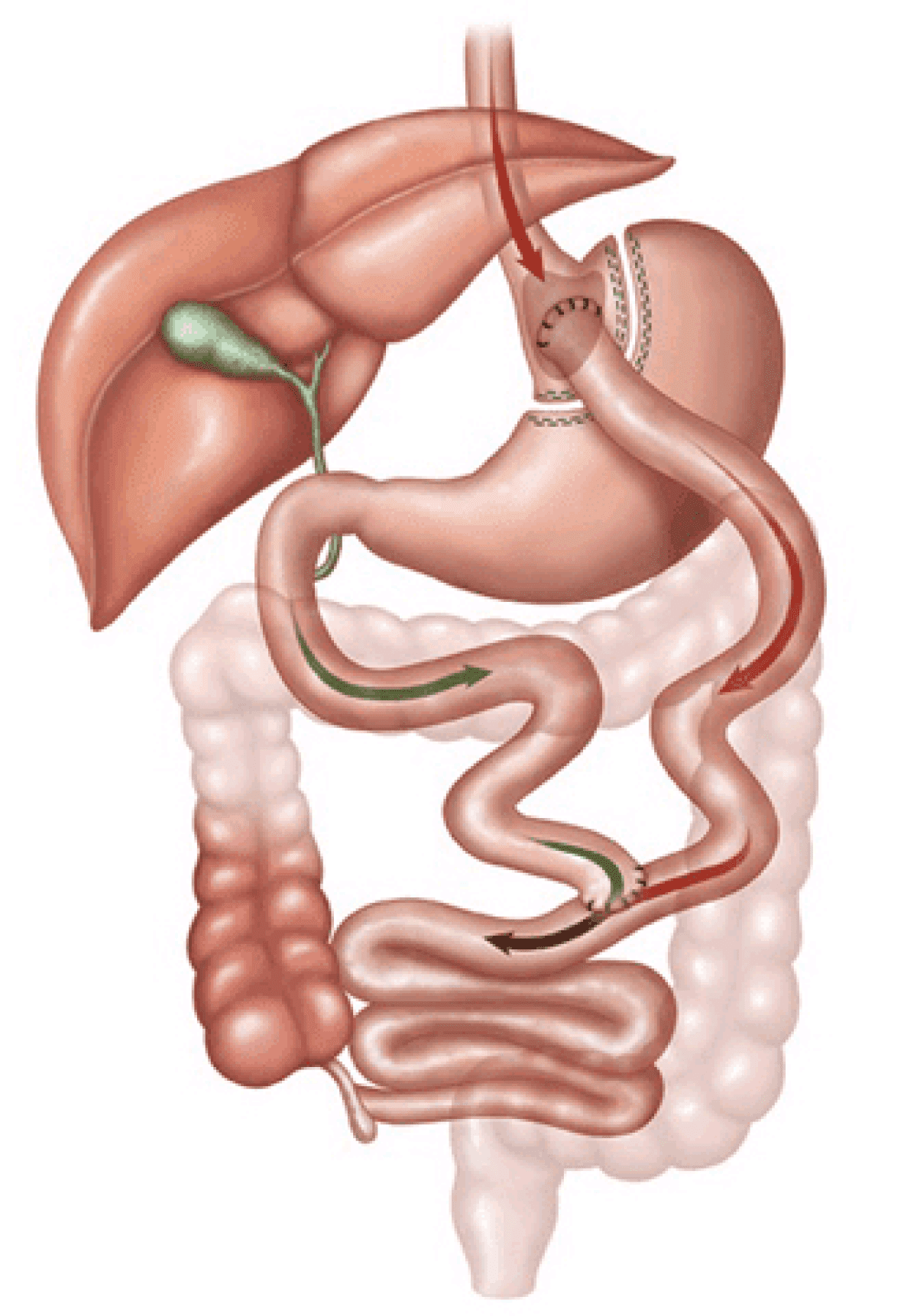 Roux-en-Y Gastric Bypass