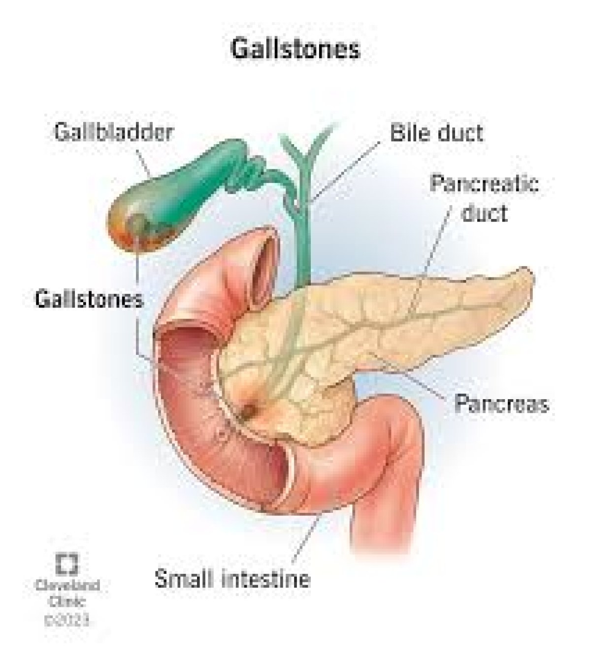 Gallbladder stones