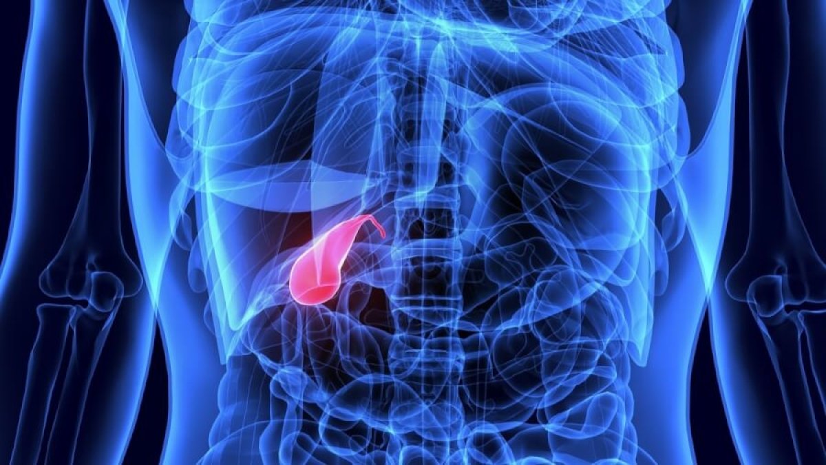 Gallbladder stones